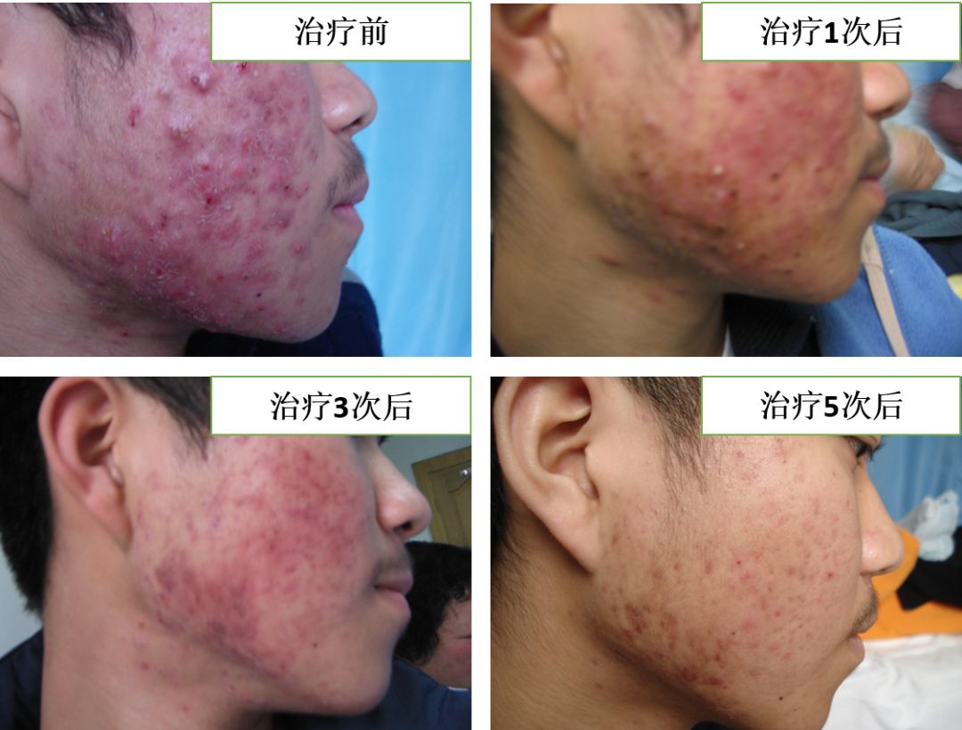 中医火针疗法教学视频,火针操作手法