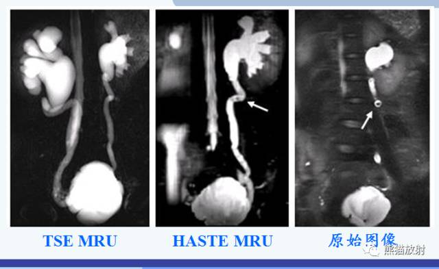 磁共振泌尿系水成像检查注意事项,磁共振影像基础知识讲解