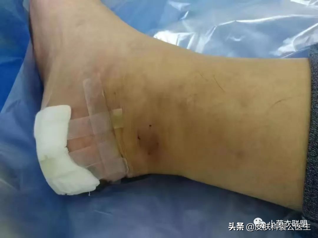 痣边缘模糊图片,痣长多大会变成黑色素瘤