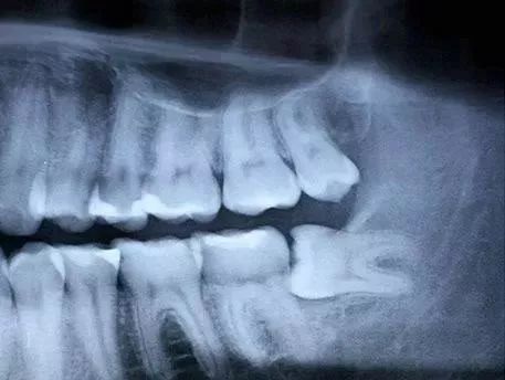 拔智齿痛到怀疑人生,拔了智齿痛的怀疑人生