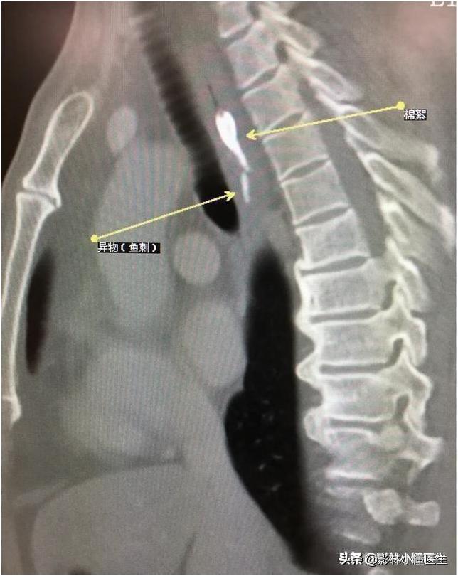 误吞假牙吃什么有助于排出,误吞假牙怎么处理