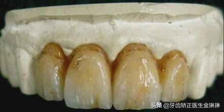 氟斑牙是什么样的图片,怎样区分氟斑牙和脱矿斑牙