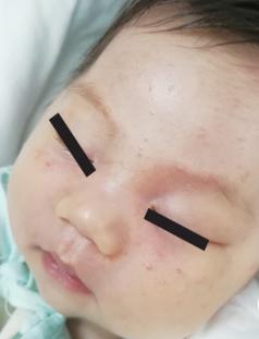 宝宝反反复复长痘痘怎么办,小宝宝常见病护理