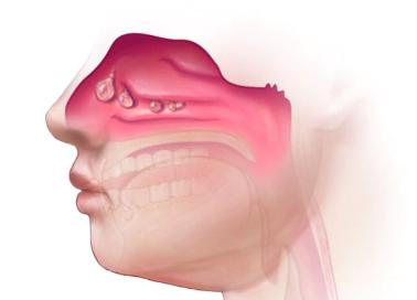 查出来有息肉需要直接做手术吗,查出息肉