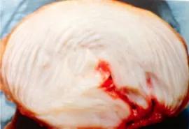 腰椎间盘突出用什么药,腰椎间盘突出正确锻炼方法