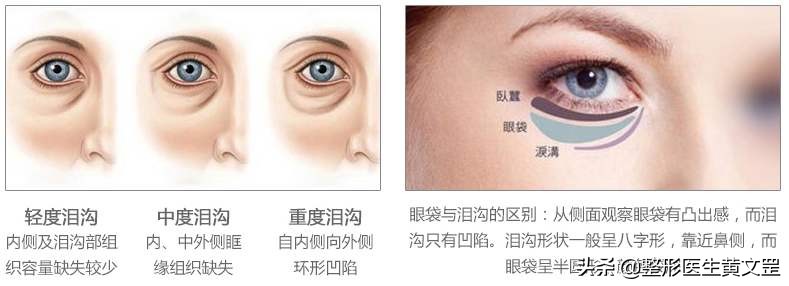 有了泪沟显老怎么办,有没有办法解决后天泪沟