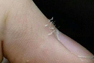 手上起倒刺缺乏什么维生素,手上倒刺最简单的去除方法