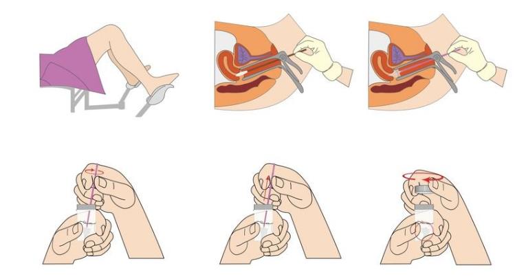 什么是TCT、HPV检查?可以和阴道镜检查同时做吗?