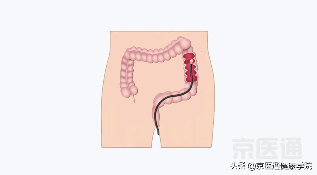胃镜鼻腔镜,胃镜和肠镜以及胃肠镜的区别