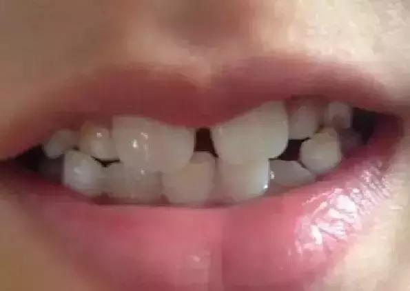 孩子新长出的门牙为什么是锯齿状,孩子的门牙长得像锯齿一样怎么办