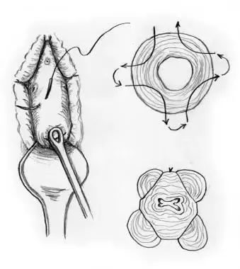 孕期宫颈环扎是怎么做,宫颈机能不全做环扎成功率有多高