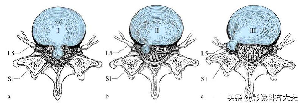 腰椎间盘突出的影像学诊断及治疗,腰椎间盘突出影像学课件