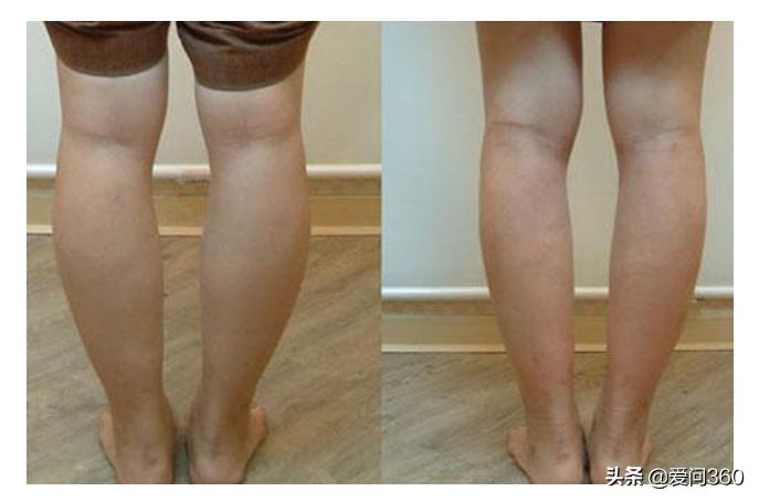 腿部粗壮、腿部肿胀别担心，学会按摩这几个穴位，坚持下去会有效