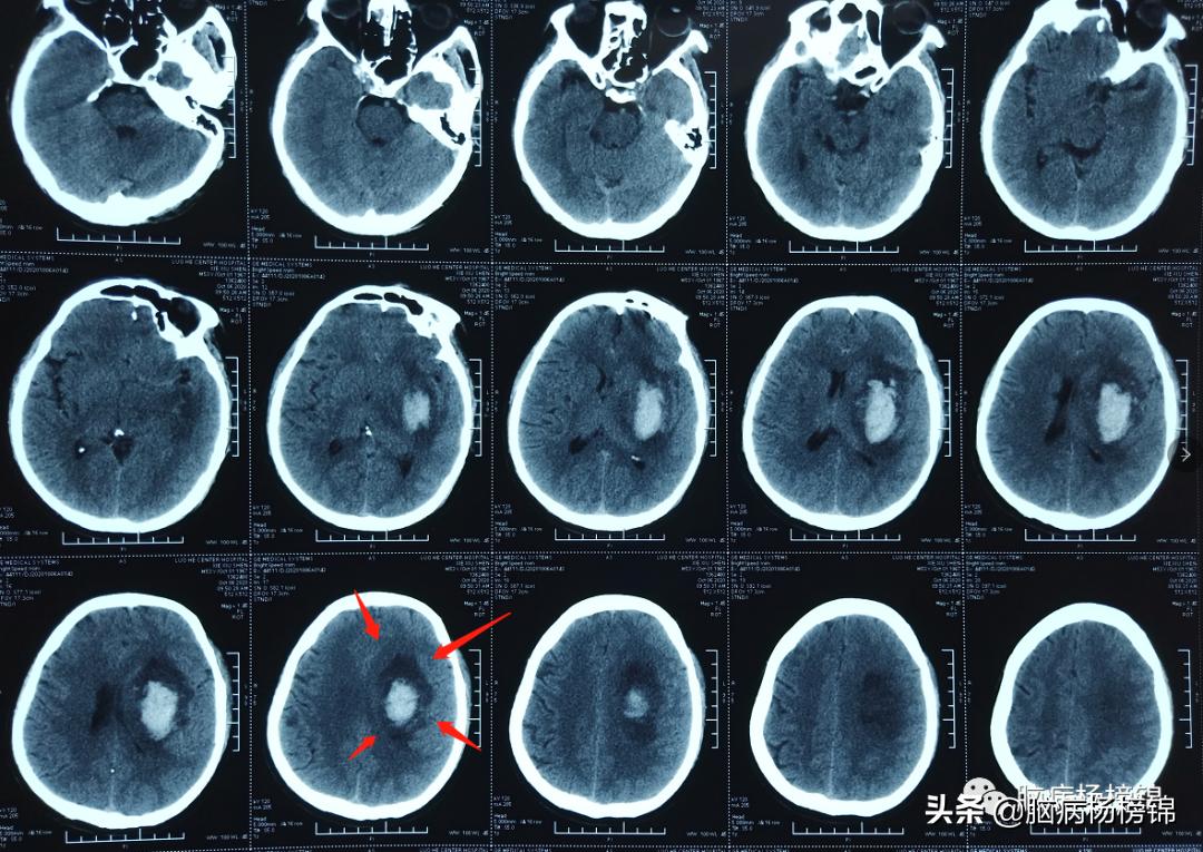 高处坠落4-6小时导致脑出血,高空作业会不会引起脑出血