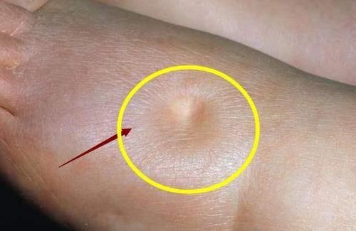 血管科普系列（一）下肢肿胀—令人忽视的血管-淋巴管因素！