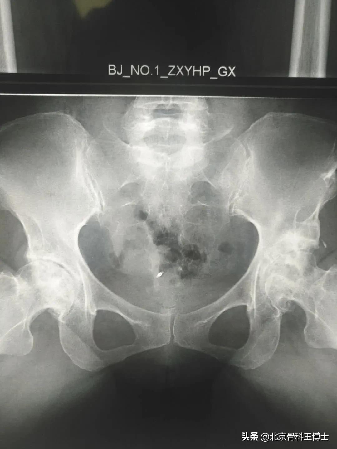 股骨头坏死,股骨头坏死前期锻炼能自愈吗