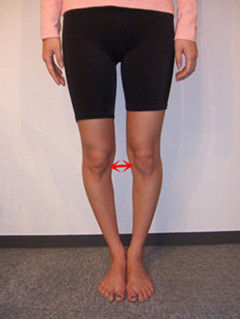 o型腿很难矫正吗,膝关节炎导致o型腿的原因