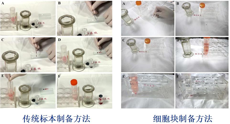 全球对肺癌治疗的最有效最新技术,肺癌的支气管镜介入治疗