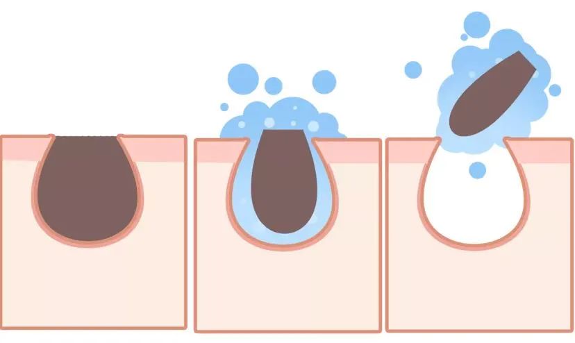 鼻子上去黑头过程,鼻子去黑头治愈系过程