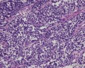 胚胎横纹肌肉瘤是怎么形成的,横纹肌肉瘤转移全身能活多久