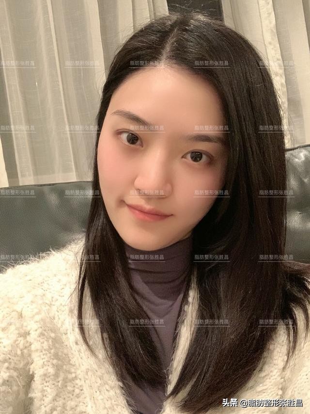 自体脂肪胶填充太阳穴泪沟法令纹,自体脂肪太阳穴填得太饱满了