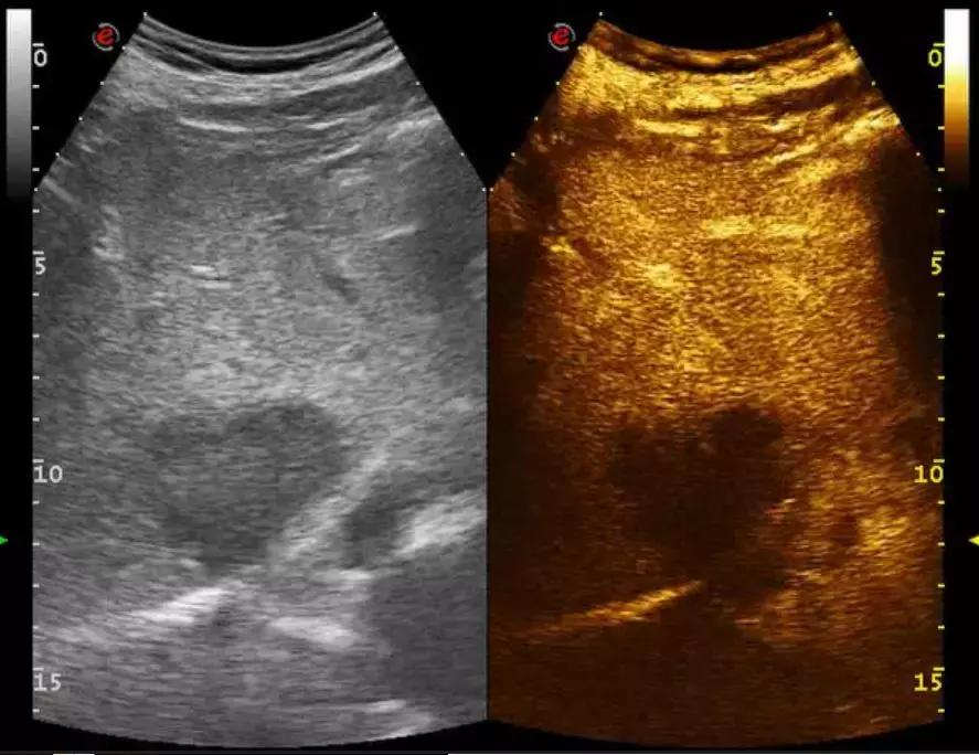 肝癌粒子植入和消融哪个好,肿瘤微波消融