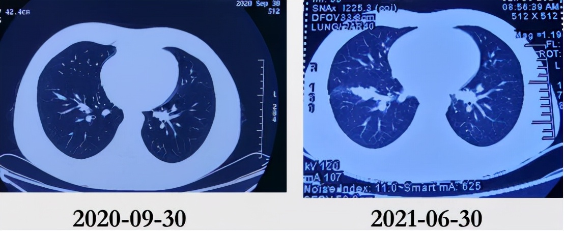 治疗后体温恢复,症状、影像仍进展,证据指向的感染竟只是迷障?