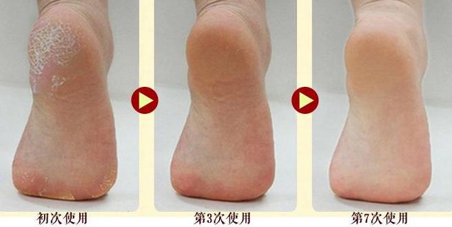 脚后跟和脚丫干裂药膏推荐,脚后跟干裂脚丫烂掉