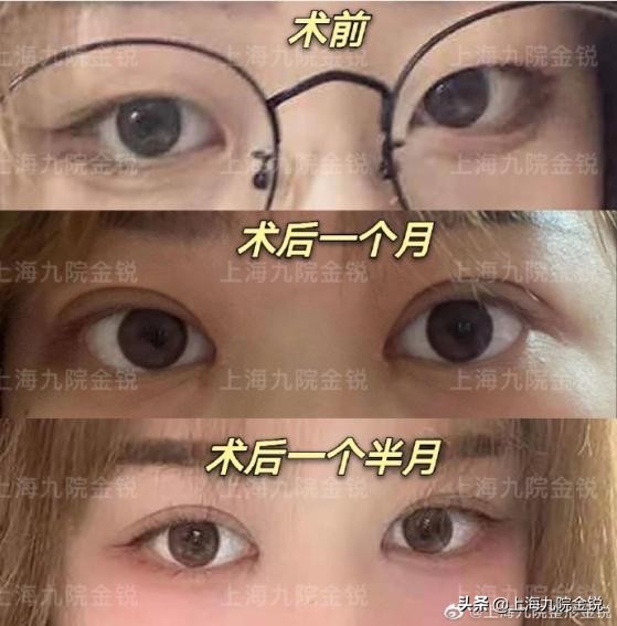 双眼皮VS单眼皮，为什么更多人喜欢双眼皮？