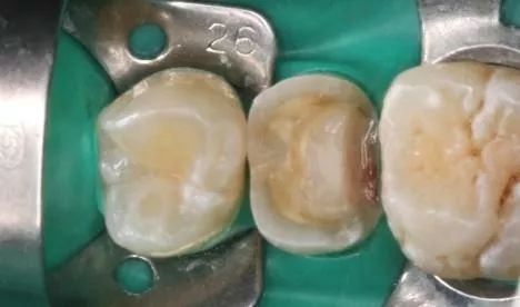 根管治疗全冠修复多少钱,根管治疗以后要做全冠吗