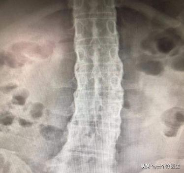 强直性脊椎炎的正骨治疗及预防