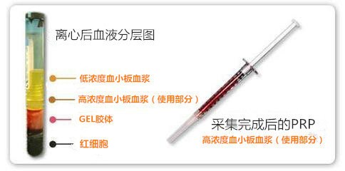 富血小板血浆治疗骨头坏死,林子洪医师