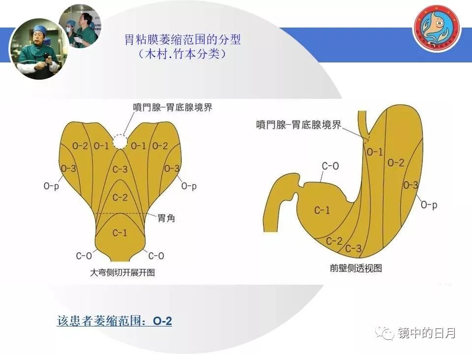 低分化胃癌早期时候做内镜手术吗,早期胃癌内镜手术后追加外科手术