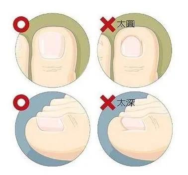 学生剪指甲,脚趾甲剪得很深