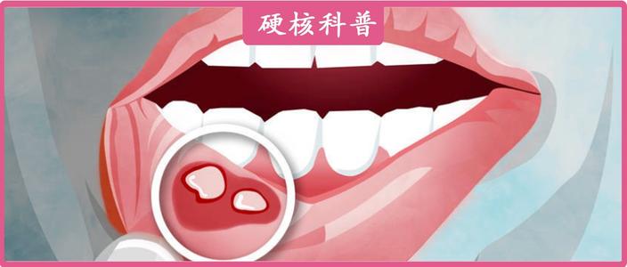 女性反复口腔溃疡是大病前兆,反复口腔溃疡是癌症的征兆吗