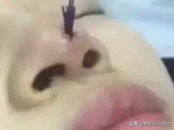线雕隆鼻的问题,线雕隆鼻的后遗症多久出现