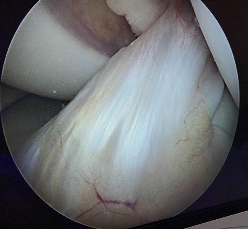 膝关节两侧有前后交叉韧带,怎么知道膝关节内侧副韧带粘连没