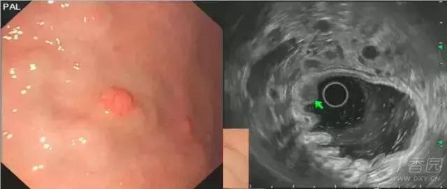 胃镜胃粘膜下隆起严重吗,胃镜提示粘膜下隆起病变