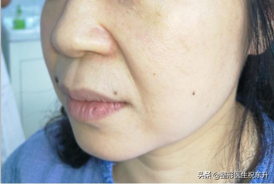 怎样可以去除法令纹和皱纹,如何消除法令纹提升脸部轮廓