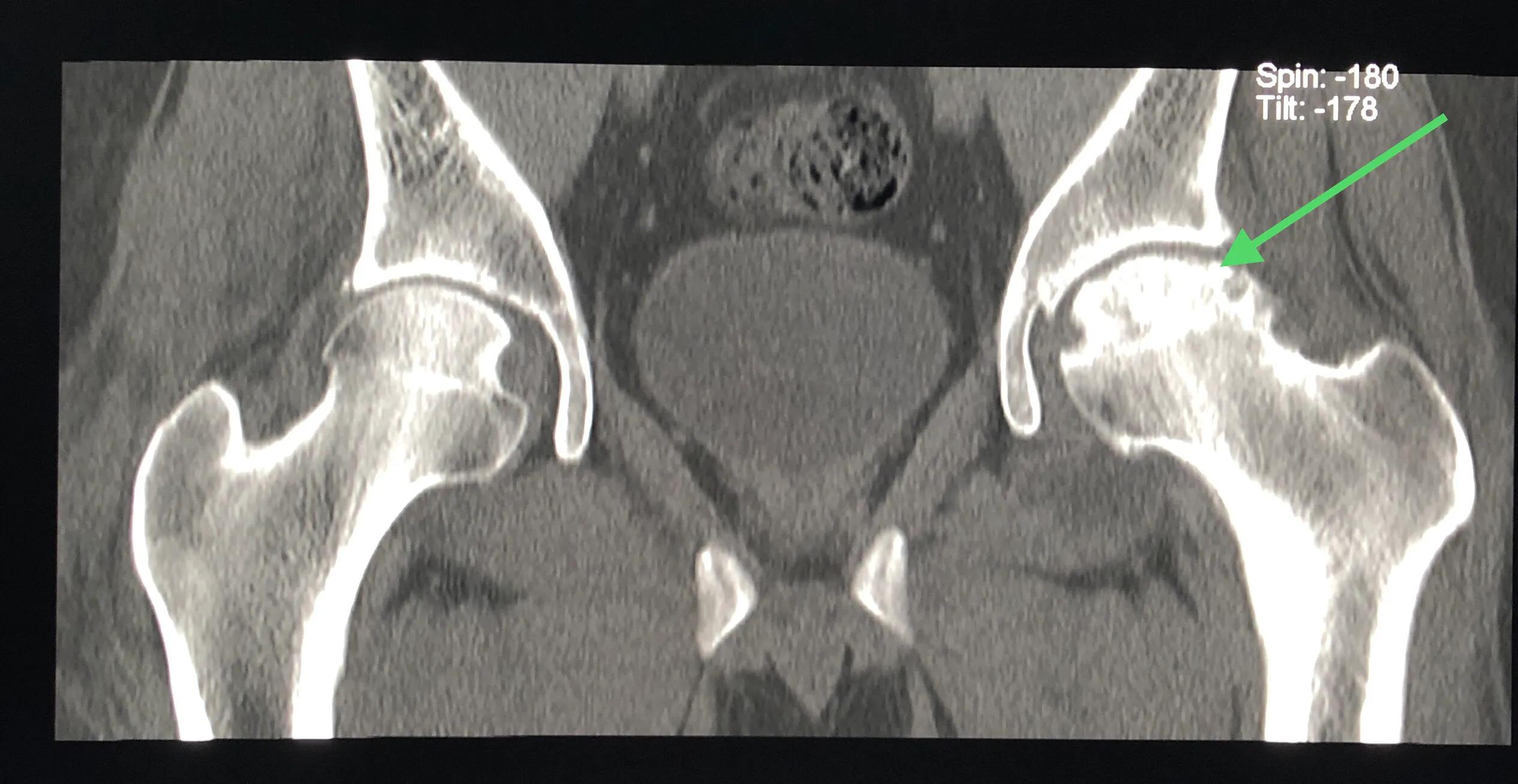 股骨头缺血性坏死的症状及治疗,股骨头缺血性坏死的分期