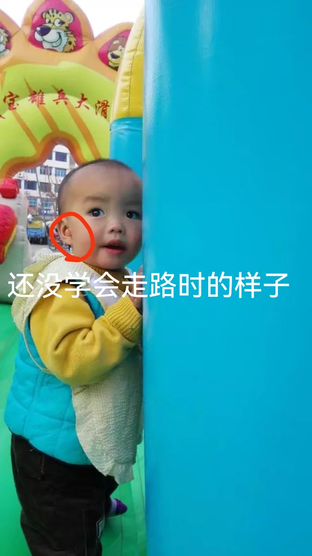 小耳畸形再造手术有后遗症吗,儿童小耳畸形去哪里做手术好