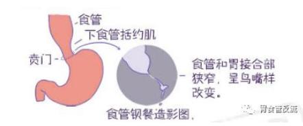 贲门吞咽困难怎么办,吞咽困难咽不下去怎么办