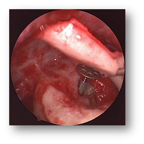 耳膜穿孔是微创手术好还是传统好,耳膜穿孔如何能免开刀低费用修补