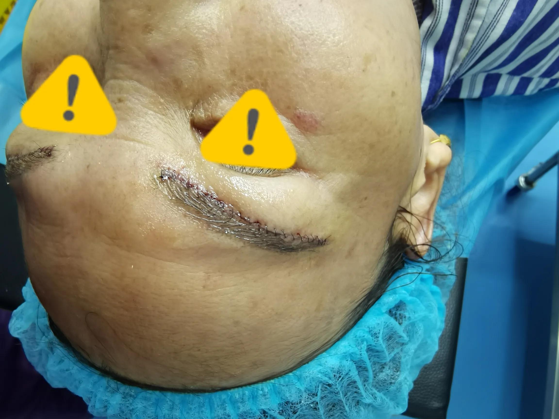 整形手术除皱会反弹吗,整形手术会不会有后遗症