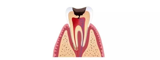 补牙补到牙齿都秃没了,补牙快到牙神经了补完咬合疼