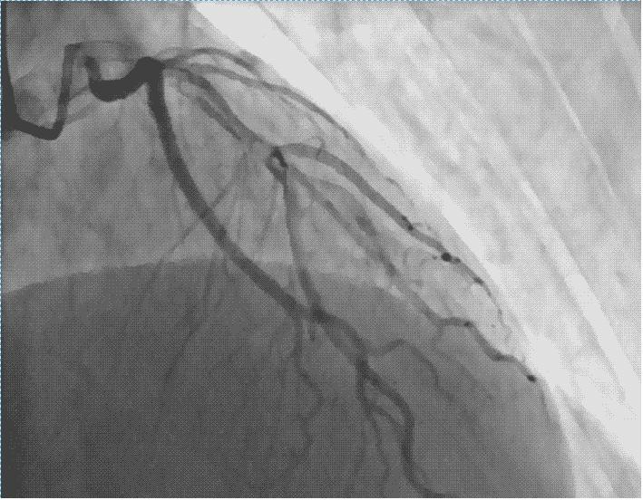 身边很多同事都得了冠心病，到底什么是冠心病？有什么治疗方法？