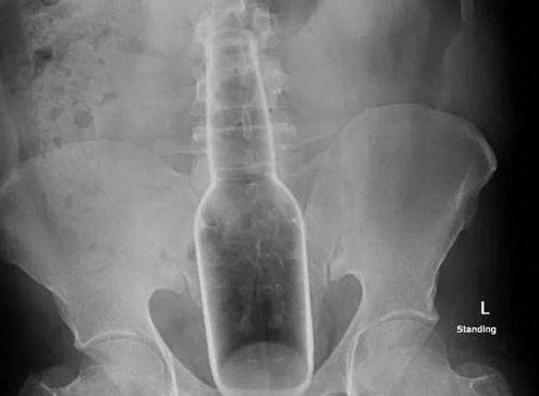 男子将18厘米长花露水瓶塞进肛门,原因令人哭笑不得