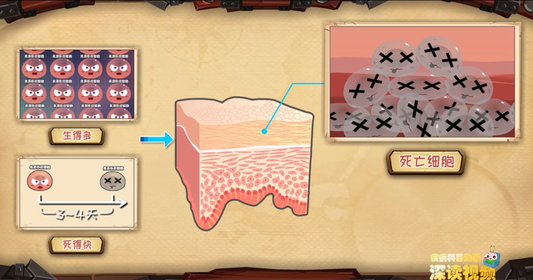 银屑病为什么会有鳞屑脱落,皮屑好治吗