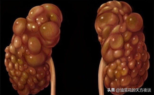 肾囊肿的原因和治疗方法,肾囊肿的病因学最新研究进展