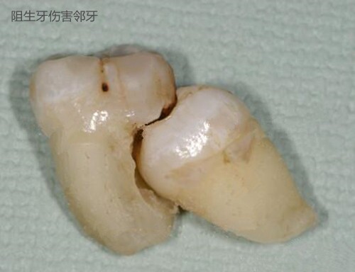 拔智齿根断在里面有什么危害,拔智齿牙根断在里面会怎么样